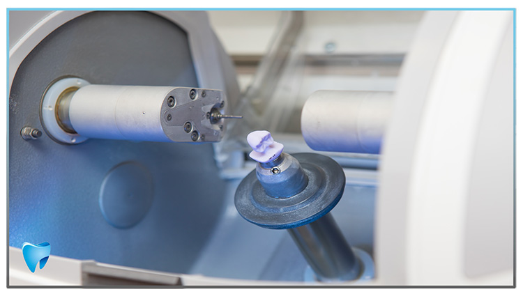 CEREC kroon of facing