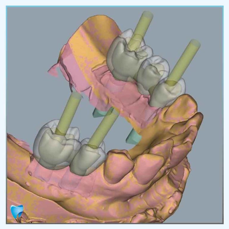 maxim clinic implantologie casus